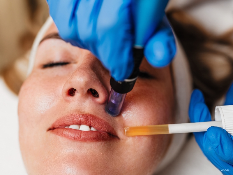 Microneedling