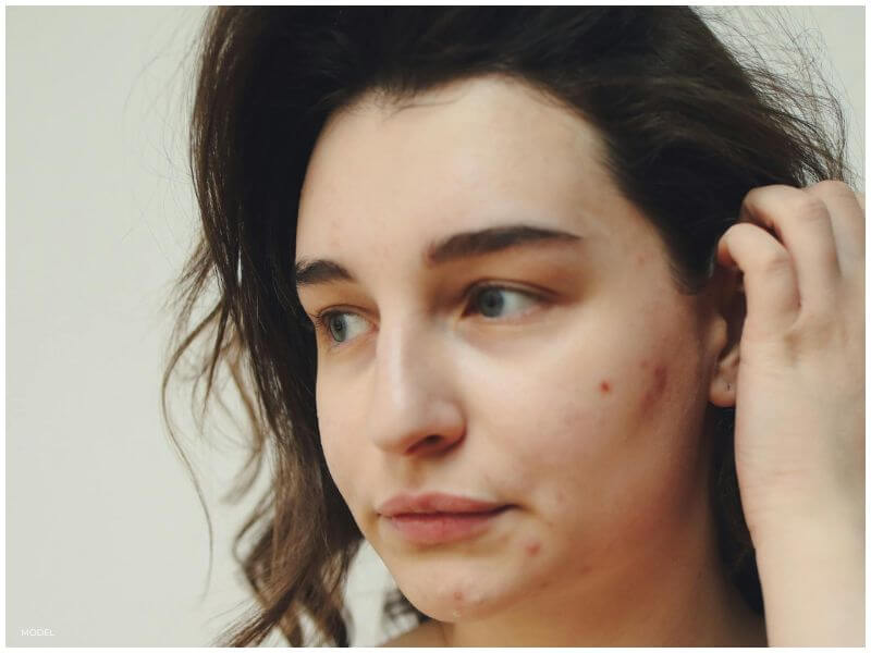 adult acne